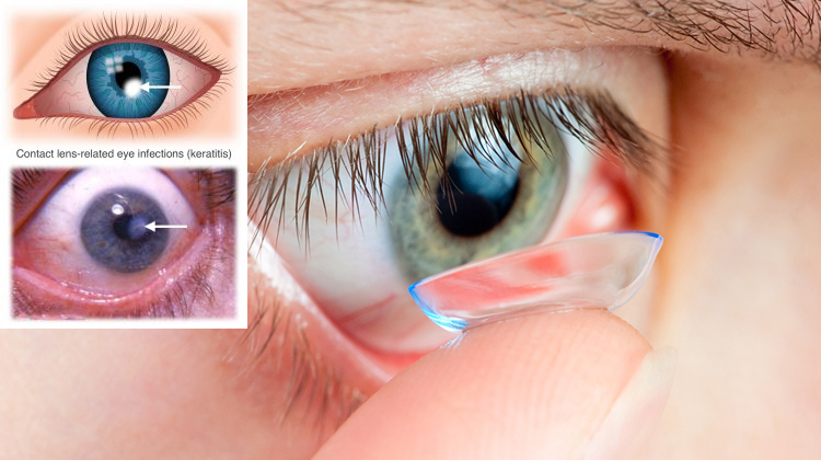 Sleeping In Contact Lenses Can Cause Dangerous Eye Infections