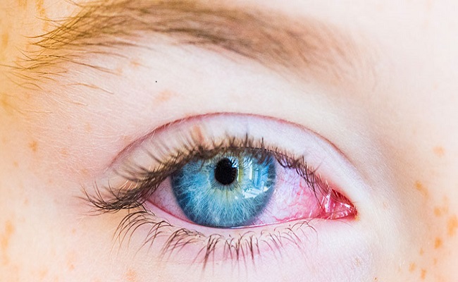 natural-remedies-for-conjunctivitis-conjectivitis-dos-and-don-ts