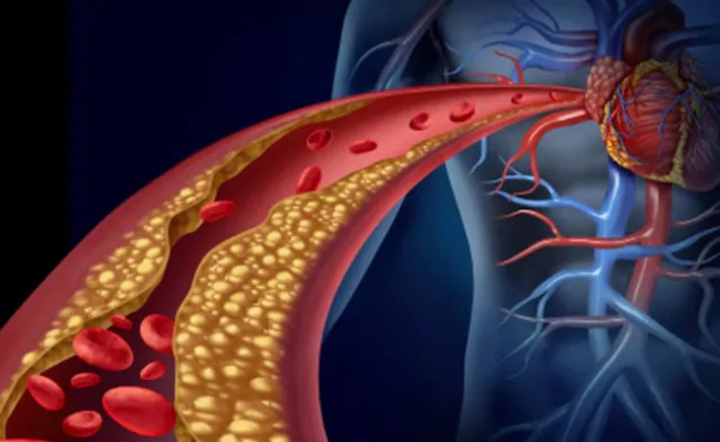 Now, an Injection to Reduce LDL Cholesterol: It Can Prevent Heart ...