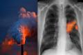 Air pollution may shorten survival chances in lung cancer patients - Sakshi Post