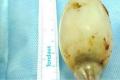 The light bulb removed from the youth’s abdomen - Sakshi Post