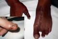 Performing a rare surgery, doctors at a hospital here gave a 35-year-old man his thumb back by grafting his big toe in its place. (Representational image)&amp;amp;nbsp; - Sakshi Post