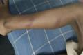 The bruises on the boy’s leg after being beaten by his class teacher&amp;amp;nbsp; - Sakshi Post