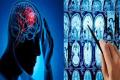 7 Warning Signs Of Brain Tumour To Be Aware Of - Sakshi Post