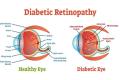 World Diabetes Day  2022: Myths And Facts On Diabetic Retinopathy - Sakshi Post