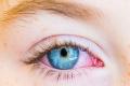 natural remedies for conjunctivitis - Sakshi Post