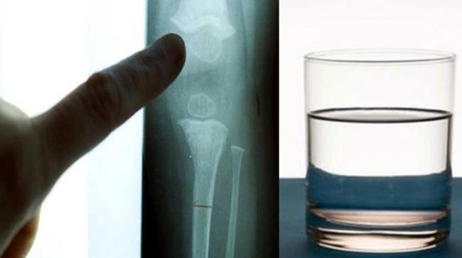 High levels of fluoride can weaken bones, leading to skeletal fluorosis - Sakshi Post