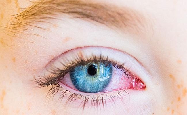 natural remedies for conjunctivitis - Sakshi Post